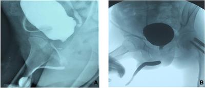 The surgical techniques of transperineal anastomotic urethroplasty for complex posterior urethral stenosis in boys and the long-term follow up outcomes